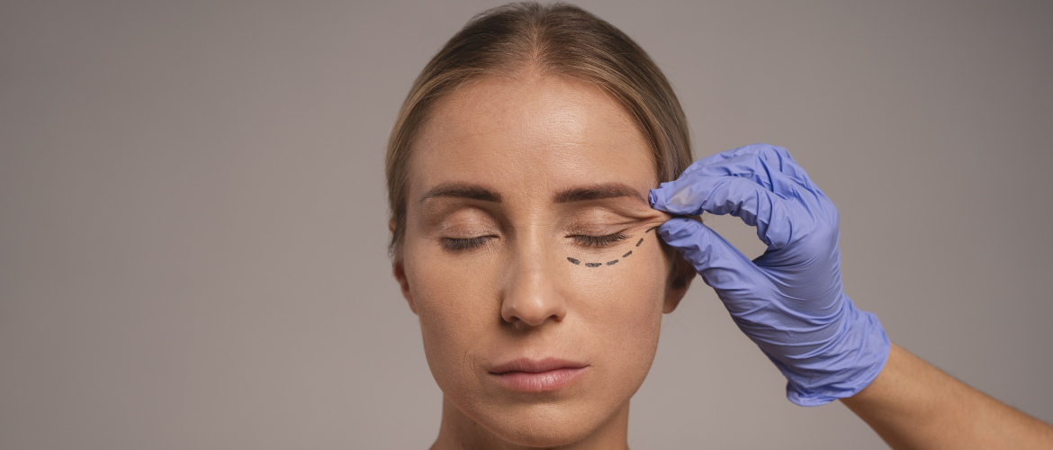 imagem_blog_blefaroplastia_1170x500.webp