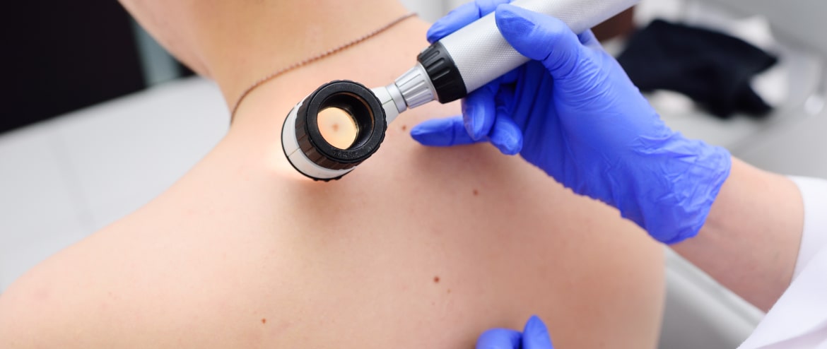 melanoma-cutaneo-saiba-min.jpg