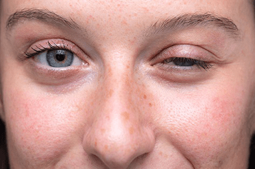 miasteniagravis-thumb.png