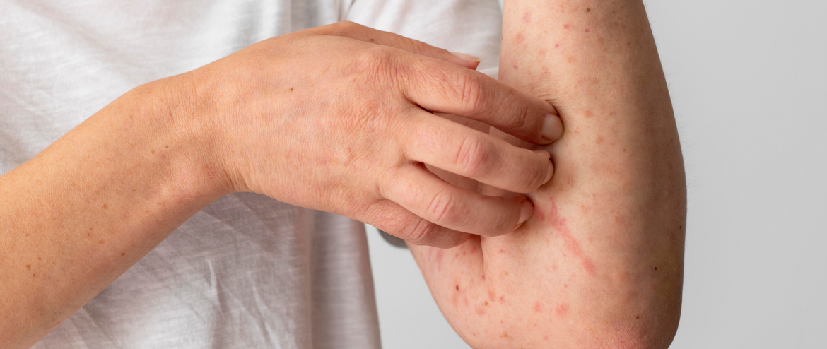 monkeypox-site.jpg