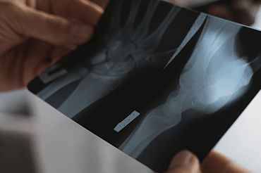 osteoporose-thumb-min.png