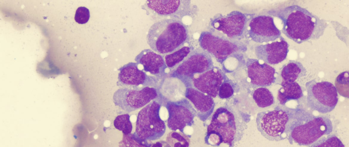 sarcoma-saiba-mais-min.jpg